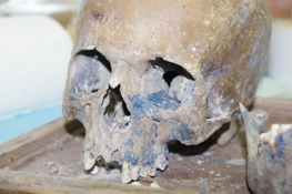 Vivianite – The Mineral That Turns Corpses a Lovely Shade of Blue